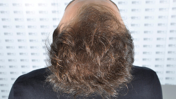 ASMED CLINIC - Koray Erdogan - MANUAL FUE Hair Transplant Result - 3806 grafts photo