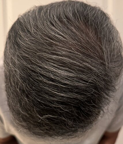 AlviArmani new FUE result 3,500 grafts - Dr. Hughes photo