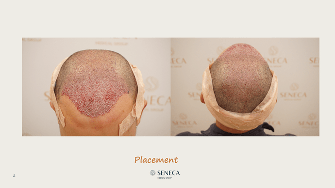 Seneca Medical Group - 3612 grafts with Direct Fue photo