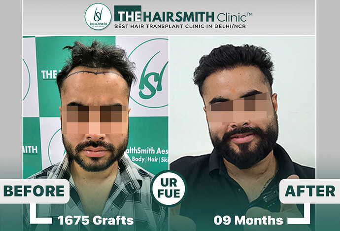 The HairSmith Clinic™ | NW Stage 3 | 1675 Grafts | 9 Months Hair Transplant Result photo