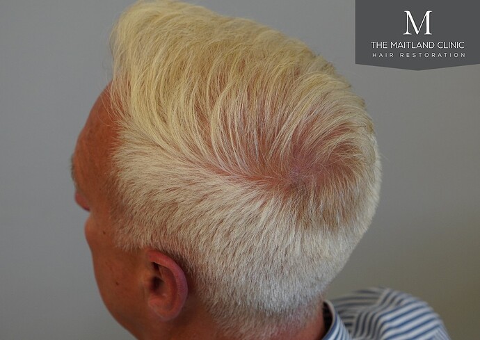 Dr Ball - The Maitland Clinic 2280 Grafts by FUE photo