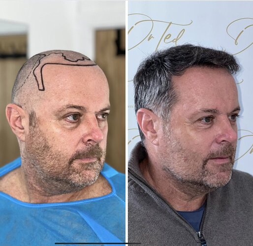 Dr Ted Miln (UK) | 6,120 grafts | FUT+FUE combo | Hairline, midscalp & crown restoration | 8.5 months post-op photo