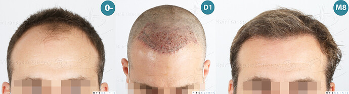 Dr. Jean Devroye, HTS Clinic / 2007 FUE / Hairline and frontal area restoration photo