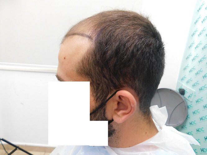 Hair Transplant Result - 15 months after for 4000 FUE Grafts on NW5 Patient – HDC hair Clinic – Dr Maras photo