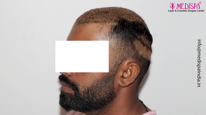 Dr. Suneet Soni - 5360 Grafts | 12-Month Result | Combination FUT + FUE + Beard photo