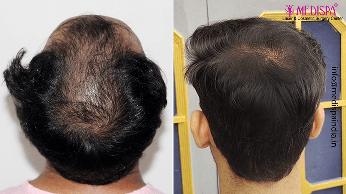 Dr. Suneet Soni - 4046 Grafts | 12-Month Result | Combination FUT + FUE + Beard photo