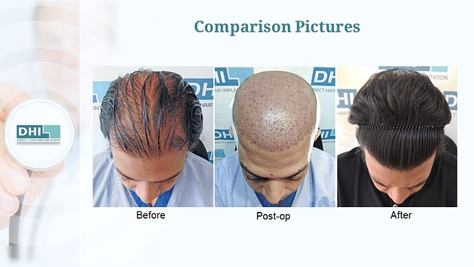 DHI India™ | 4,133 Grafts | Diffuse Alopecia | Full Coverage in 6 Months photo