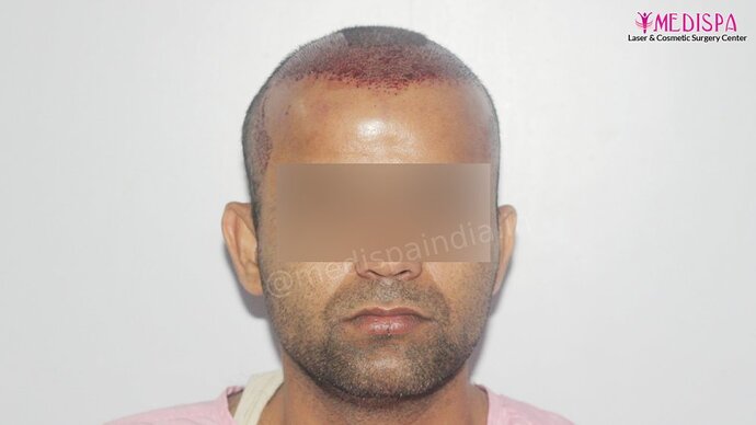 Dr. Suneet Soni - 4025 Grafts | 12-Month Result | Combination FUT + FUE photo