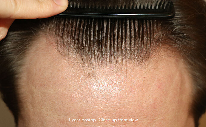 Case performed by Dr. Feriduni – 3322 FU in 1 procedure photo