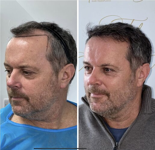 Dr Ted Miln (UK) | 6,120 grafts | FUT+FUE combo | Hairline, midscalp & crown restoration | 8.5 months post-op photo