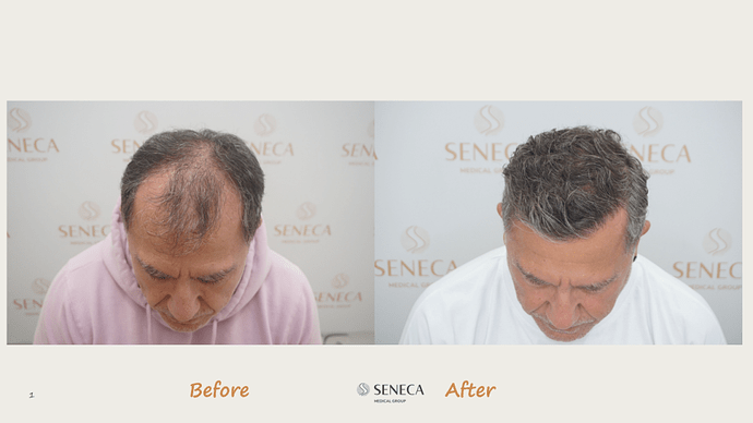Seneca Medical Group - 3000 grafts with Direct Fue photo