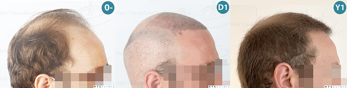 Dr. Jean Devroye, HTS Clinic / 3054 FUE / Hairline & front-mid restoration photo