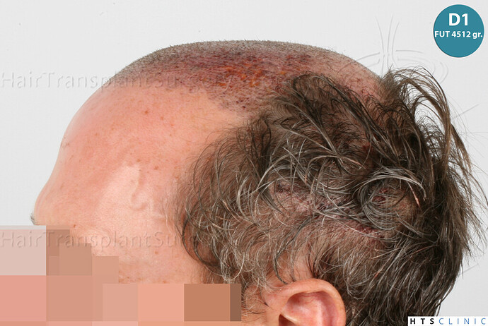 Dr Devroye + Dr Montesanti + Dr Jenard / 7015 grafts (4512 FUT + 2503 FUE) / 2 sessions photo