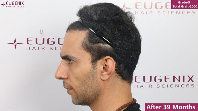 EUGENIX HAIR SCEINCES | GRADE 3 | 39 MONTHS RESULT| Dr. Pradeep Sethi photo