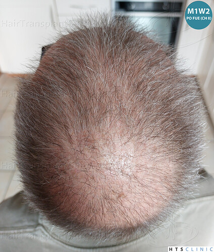 Dr Devroye + Dr Montesanti + Dr Jenard / 7015 grafts (4512 FUT + 2503 FUE) / 2 sessions photo