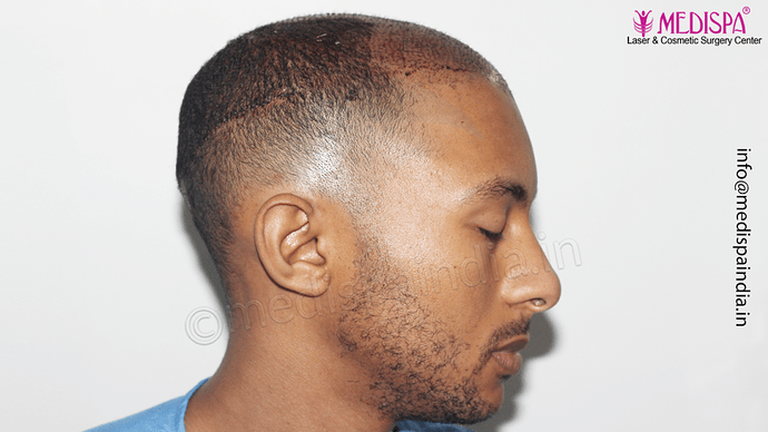 Dr. Suneet Soni - Afro Hair Transplant, 2 Sessions, 8355 Grafts, Combined FUT + FUE Technique, NW-VI, 5 Years Result photo