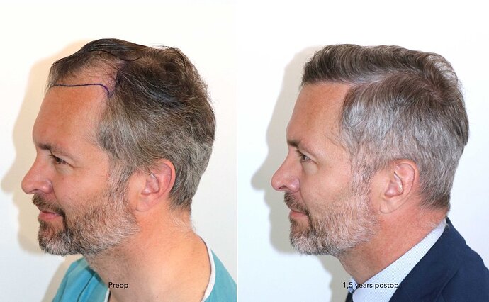 Case performed by Dr. Feriduni – 3242 FU in 1 procedure photo