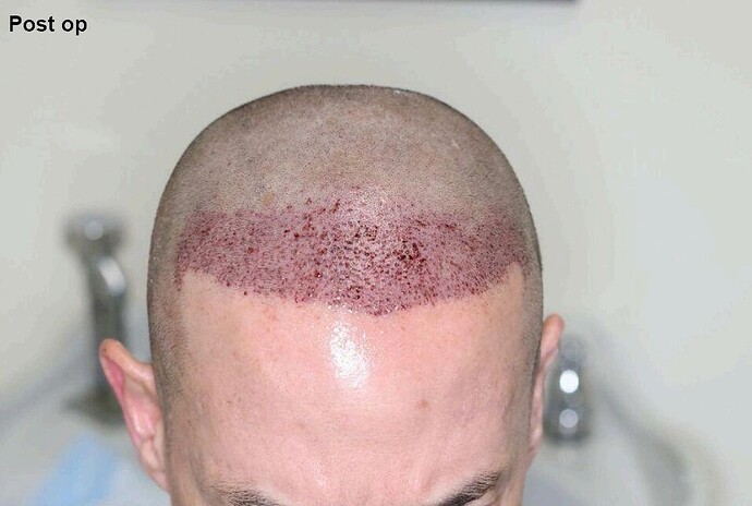 Dr. Ischayek hair restoration result - 1,075 grafts alviarmani photo