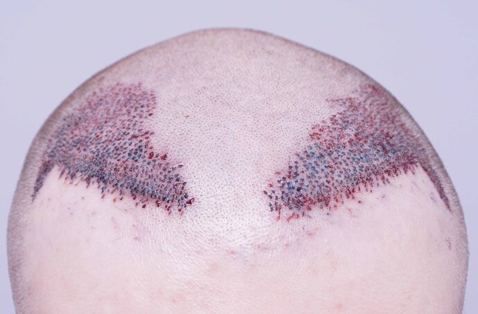 Dr B Farjo 1560g FUE (Frontal) photo