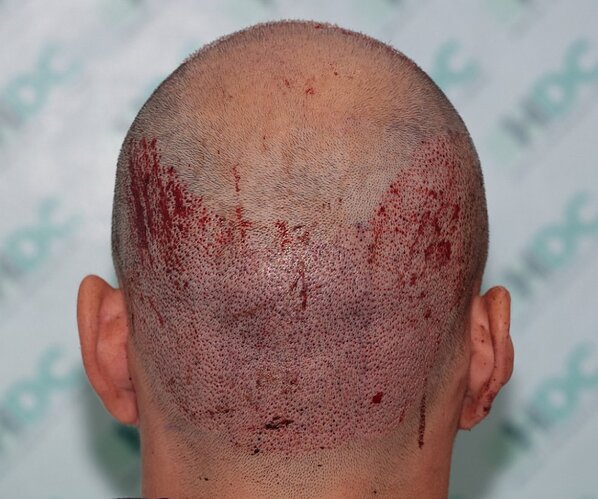 Two FUE Surgeries Totaling 6560 Grafts – HDC Hair Clinic photo