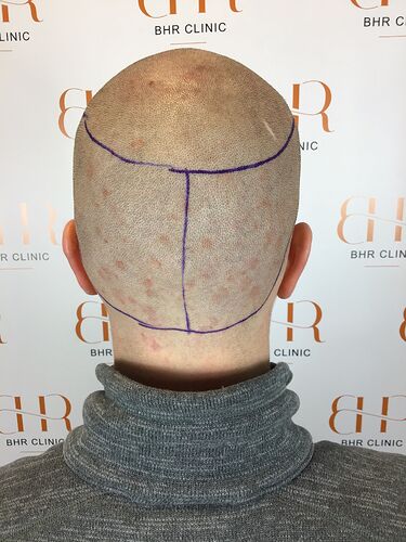 Dr.Bisanga, BHR Clinic, 2977 FUE 0 - 7 Months. photo