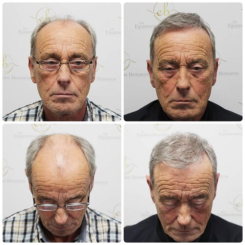 Dr Bonaros, Glasgow, UK / 3524 FUE grafts / 0-12 Months photo