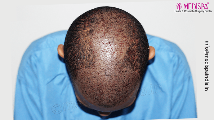 Dr. Suneet Soni - Afro Hair Transplant, 2 Sessions, 8355 Grafts, Combined FUT + FUE Technique, NW-VI, 5 Years Result photo