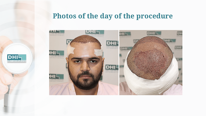 Full Scalp Coverage – 3511 Grafts | DHI India Result photo