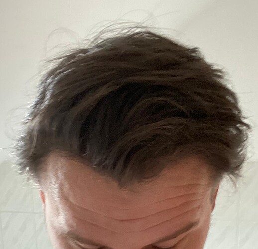 Hairline FUE Result for 2500 Grafts – 8 Months After – HDC Hair Clinic photo