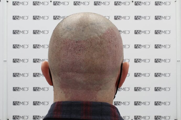 ASMED CLINIC - DR.KORAY - 5060 GRAFTS FUE photo
