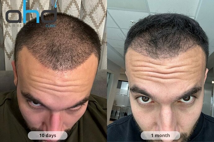 AHD Clinic / Technicians / 4050 grafts / FUE + DHI photo