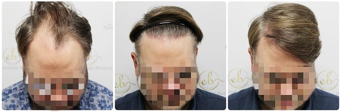 Dr Bonaros, Glasgow, UK / 3207 FUE grafts / 0-12 Months photo