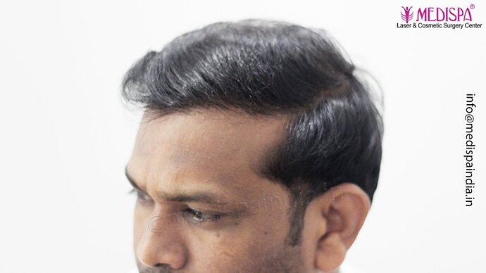 Dr. Suneet Soni - 5498 Grafts, 2 Years Result, Combine FUT + FUE + Beard Technique, NW-VI photo