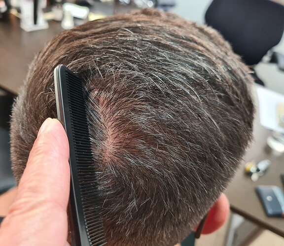 Hairline and crown - 4000 FUE Grafts – Dr Christina – HDC Hair Clinic photo