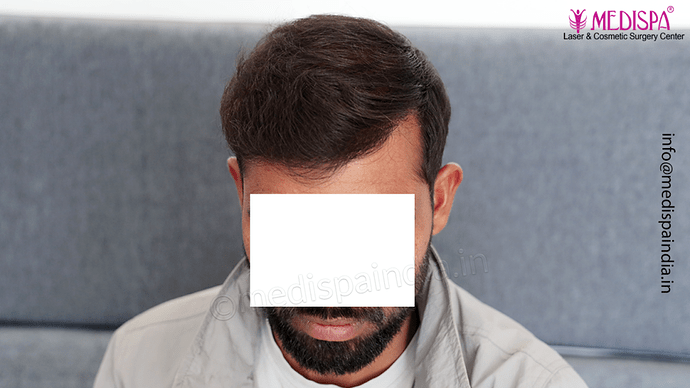 Dr. Suneet Soni - 5360 Grafts | 12-Month Result | Combination FUT + FUE + Beard photo