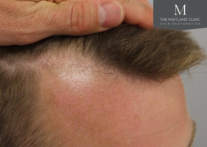 Dr Ball - The Maitland Clinic 1204 Grafts By FUE photo