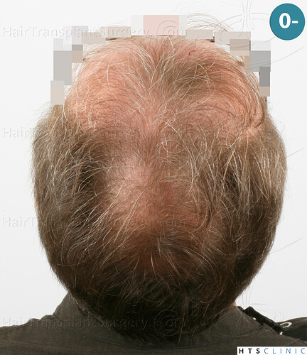 Dr Devroye + Dr Montesanti + Dr Jenard / 7015 grafts (4512 FUT + 2503 FUE) / 2 sessions photo