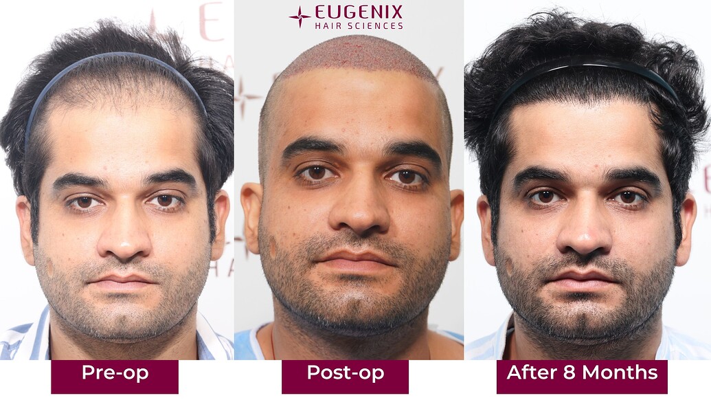 https://cdn.forumhairtransplant.com/optimized/3X/7/b/7b2ee1b19a787f0ab2ae7f07899d67bc047b54ed_2_1035x582.jpeg
