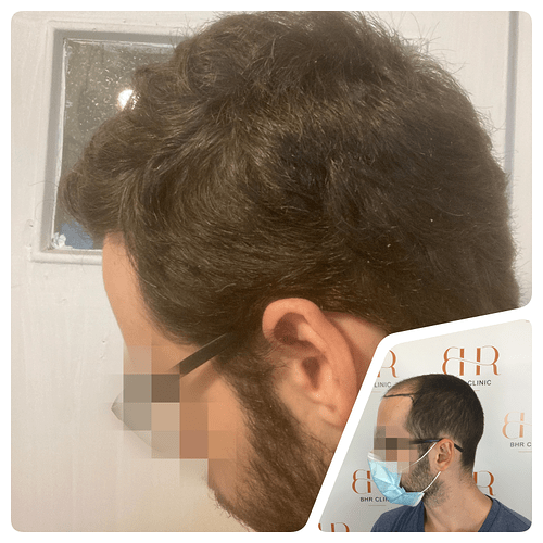 Dr. Bisanga - BHR Clinic - 4000 FUE 0 - 8 Months photo