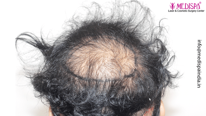 Dr. Suneet Soni - 5467 Grafts, Combine FUT + FUE + Beard Technique, NW- V, 3 Years Result photo