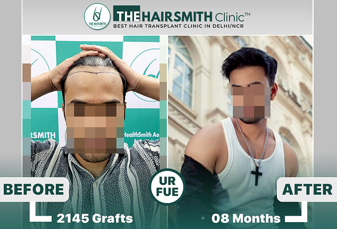 The HairSmith Clinic™ | NW Stage 3 | 2145 Grafts | 8 Months Hair Transplant Result photo
