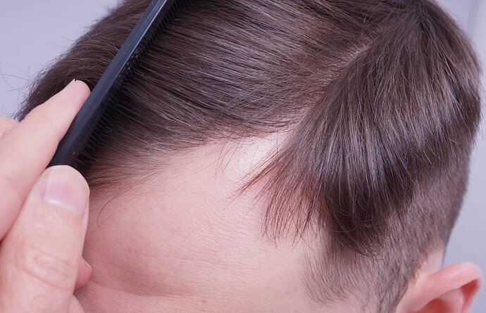Dr B Farjo 1560g FUE (Frontal) photo