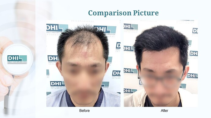 DHI India | NW 5 | 5,319 Grafts | 7-Months DHI Hair Transplant Results photo