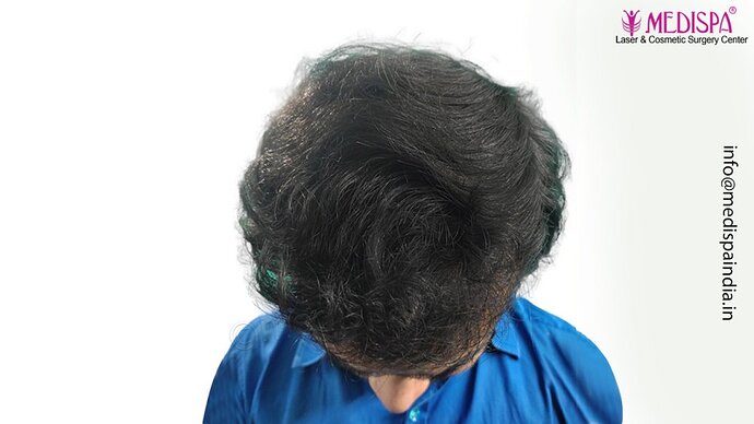 Dr. Suneet Soni - 5000 Grafts, Combine FUT + FUE + Beard Technique, NW-V photo