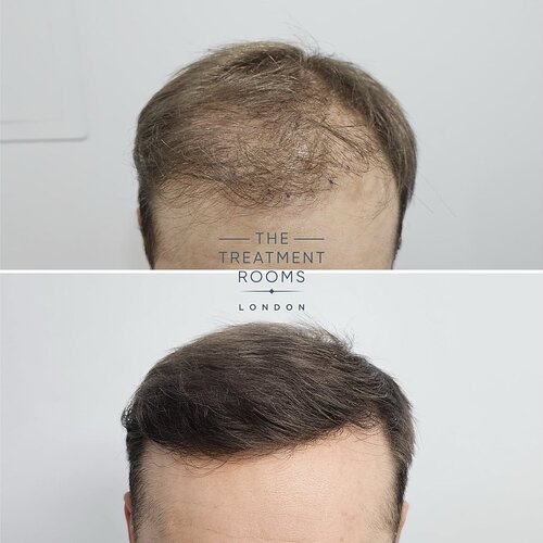 Hair Transplant Repair- 1733 Grafts photo