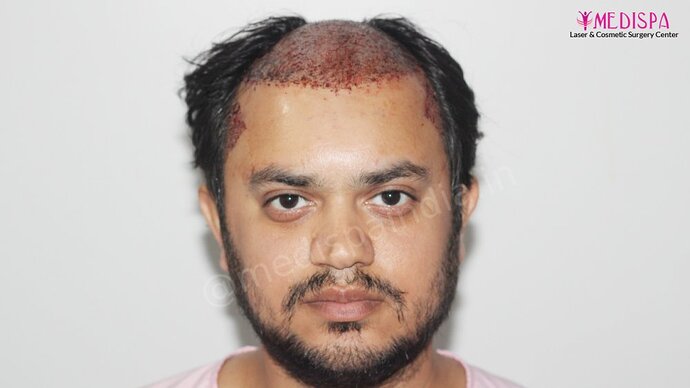 Dr. Suneet Soni - 4937 Grafts, Combine FUT + FUE Technique, NW : IV-V photo