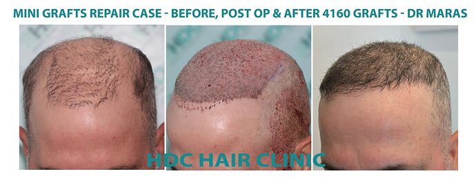 Major Repair of Mini Grafts - Result: 4160 Grafts – HDC Hair Clinic photo