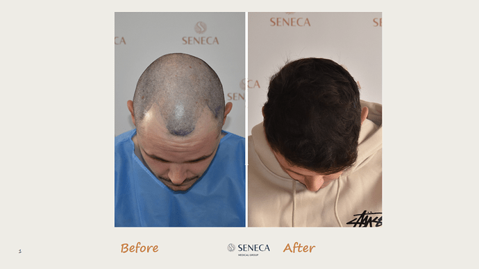 Seneca Medical Group - 1346 grafts with Direct Fue photo