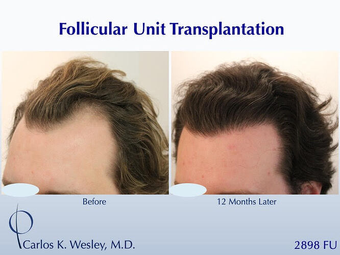 #BAM Hairline and Temples + a Light Crown Coverage (2898 FUT grafts): Carlos K. Wesley, M.D. (NYC & LA) photo