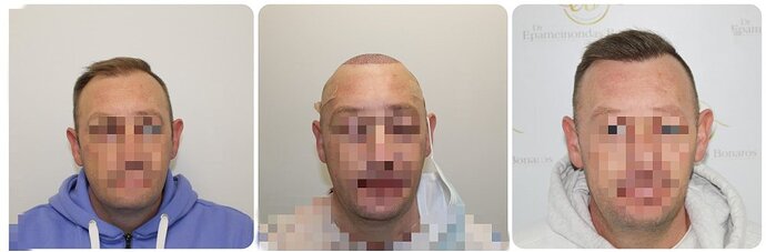 Dr Bonaros, Glasgow, UK / Receding Hairline Hair Transplant Result / 1814 FUE grafts / 0-12 Months photo